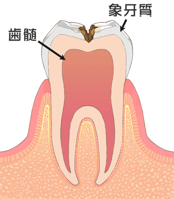 西尾市　歯医者　横須賀歯科診療所　虫歯