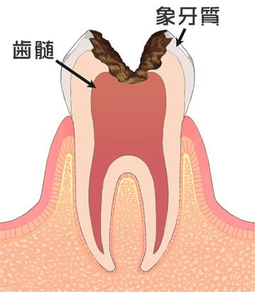 西尾市　歯医者　横須賀歯科診療所　虫歯