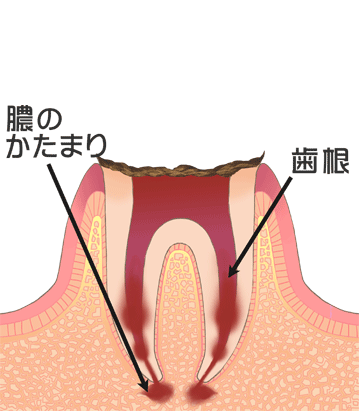 西尾市　歯医者　横須賀歯科診療所　虫歯