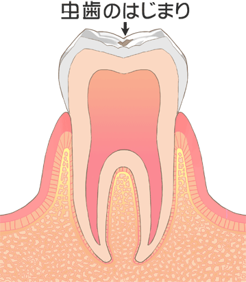 西尾市　歯医者　横須賀歯科診療所　虫歯