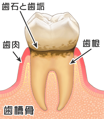 西尾市　歯医者　横須賀歯科診療所　歯周病