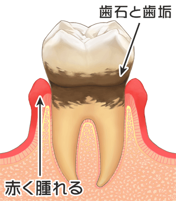 西尾市　歯医者　横須賀歯科診療所　歯周病