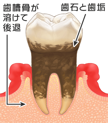 西尾市　歯医者　横須賀歯科診療所　歯周病