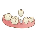 西尾市　歯医者　横須賀歯科診療所　インプラント