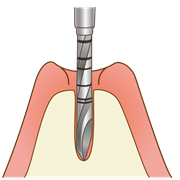 インプラント　１次オペ